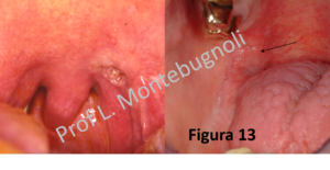 tumore gola papilloma virus sintomi