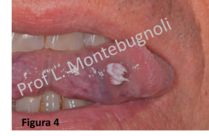 Papilloma virus sulla lingua sintomi Papilloma lingua dolore