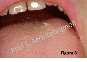 bocca con papilloma virus