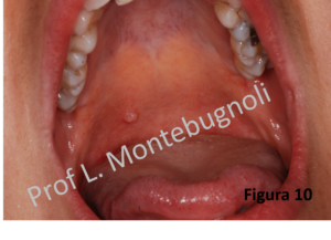 Papilloma gola intervento