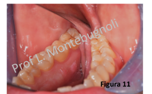 tumore lingua papilloma virus tratament de negi