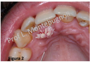 papilloma virus in bocca sintomi