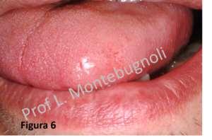 papilloma virus verruche lingua