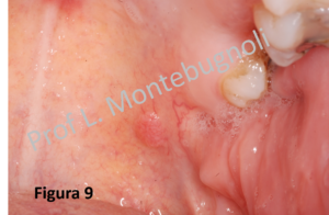 papilloma interno bocca papillomavirus behandeling