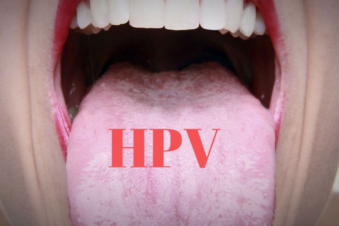 sintomi del papillomavirus in gola