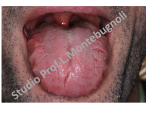 papilloma dorso lingua)